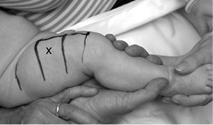 Intramuscular injection technique Intramuscular injection technique